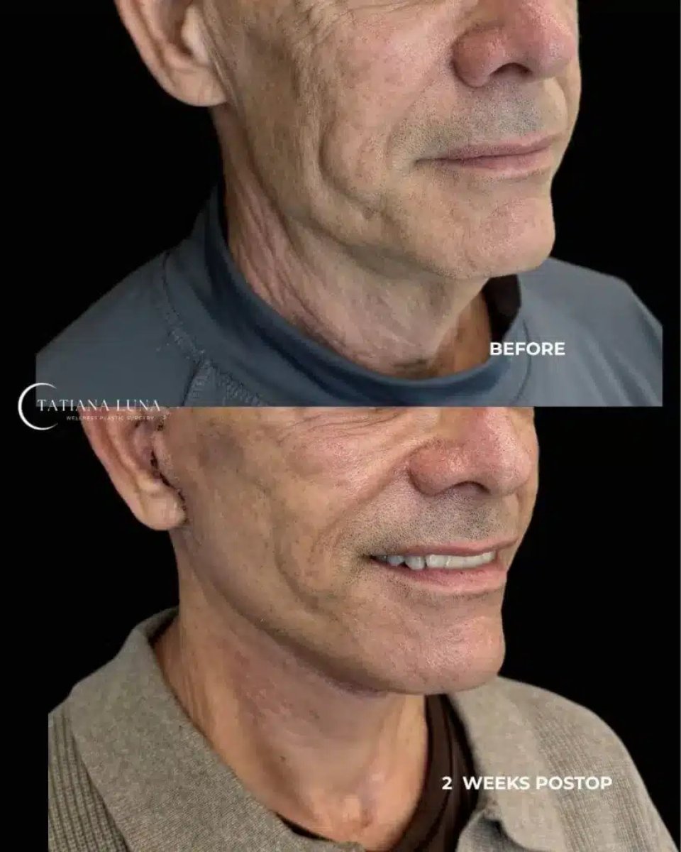 Resultados de deep plane facelift antes y después en Tatiana Luna Clinic – rejuvenecimiento facial