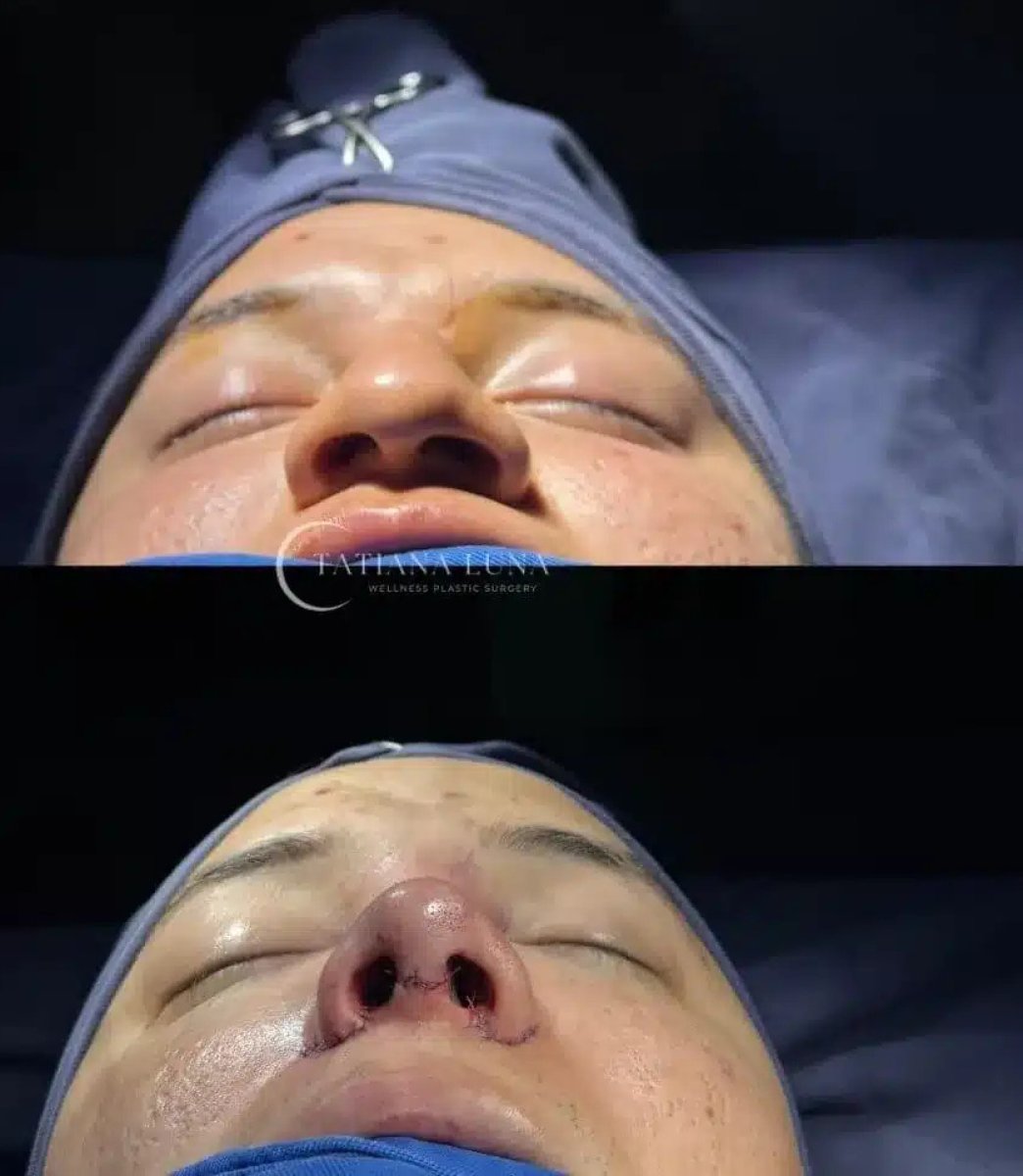 Resultados de rinoplastia antes y después en Tatiana Luna Clinic, remodelación nasal
