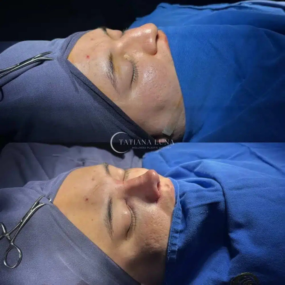 Before and after rhinoplasty results at Tatiana Luna Clinic, nose reshaping improvement