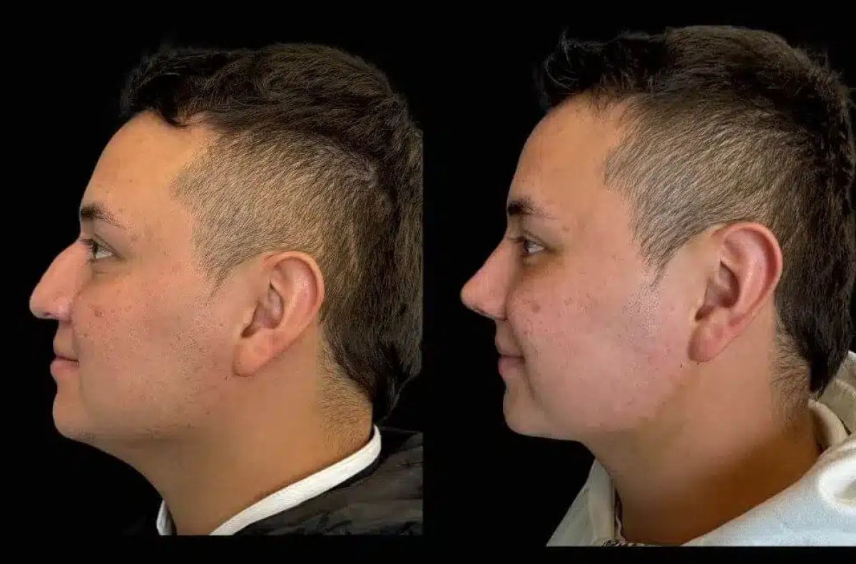 Resultados de rinoplastia antes y después, mejora de la forma y perfil nasal tras cirugía