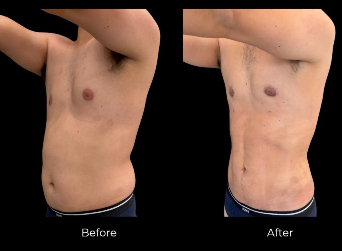 Resultados de liposucción antes y después en hombre – contorno abdominal mejorado