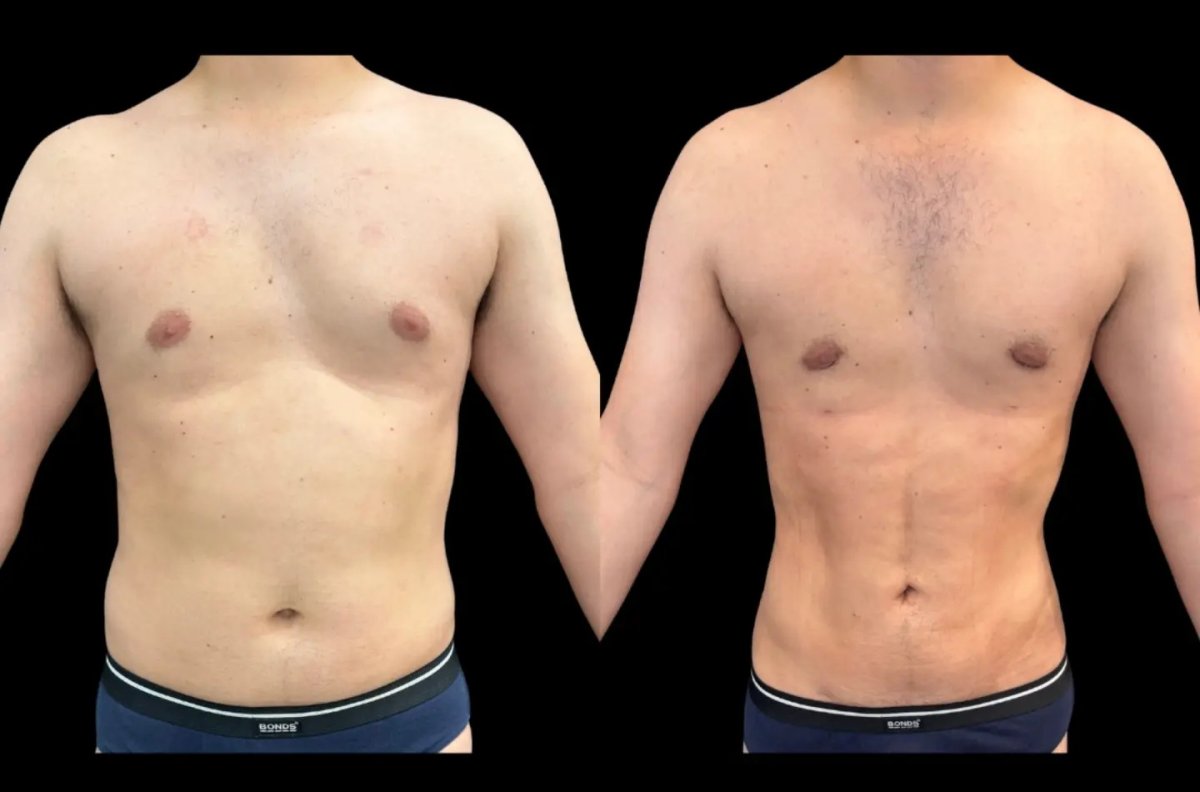 Resultados de liposucción antes y después: mejora visible del contorno abdominal en hombre