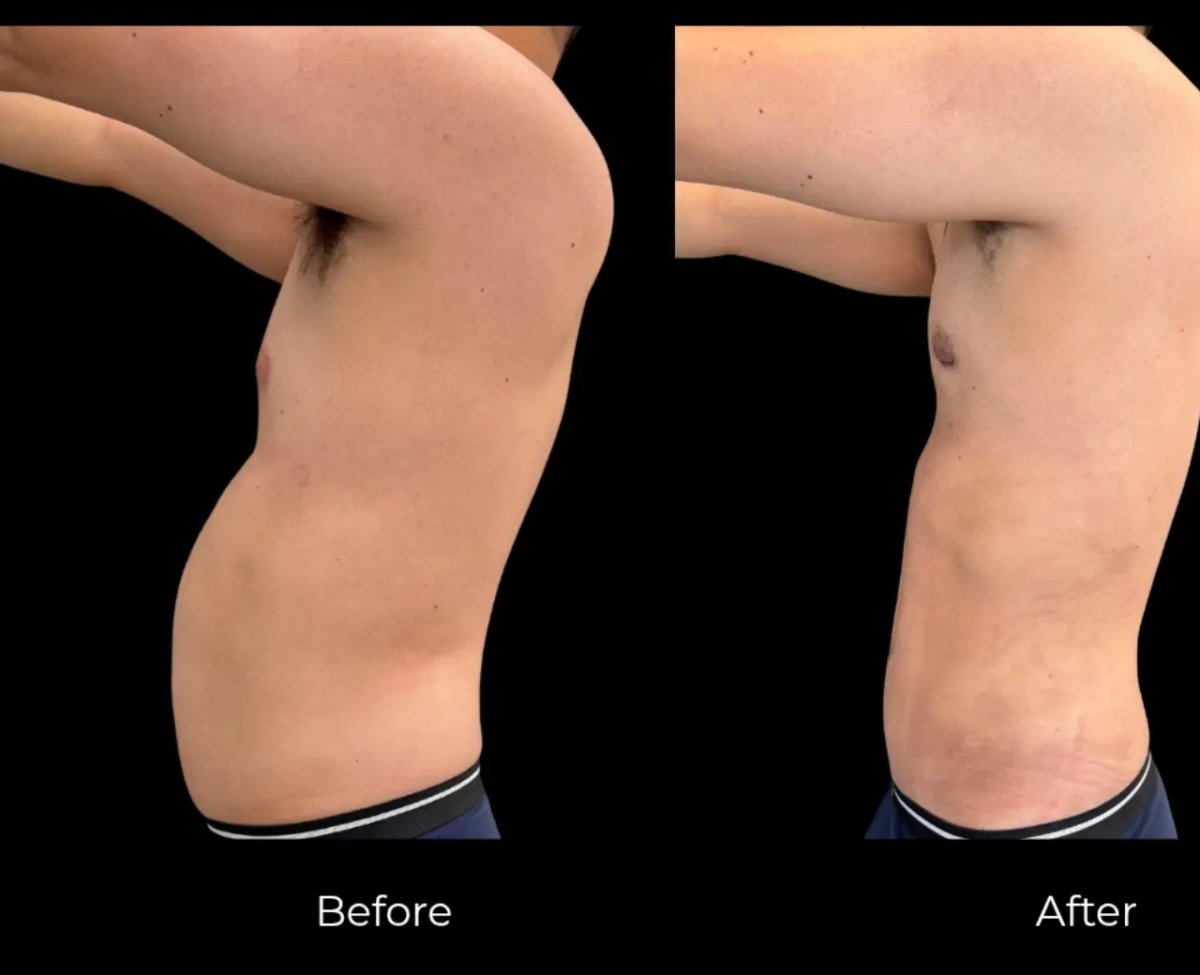Resultados de liposucción antes y después: mejora visible del abdomen en paciente masculino