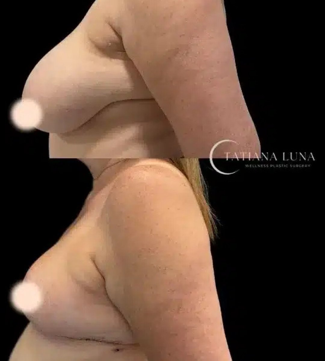 Resultados antes y después de reducción de senos en Tatiana Luna Wellness Plastic Surgery