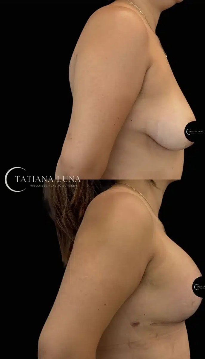 Resultados antes y después de aumento de senos en Tatiana Luna Clinic, forma mejorada