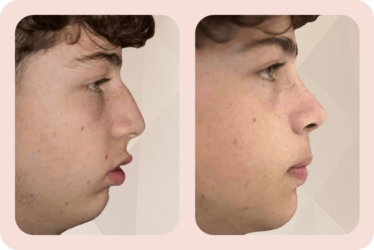 Resultados antes y después de aumento de mentón – perfil y equilibrio facial mejorados