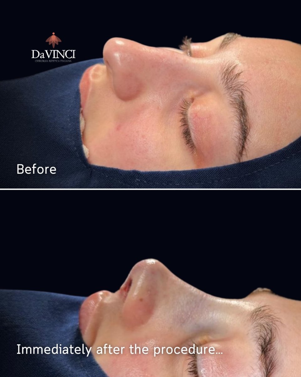 Resultados de rinoplastia antes y después en clínica DaVINCI, contorno nasal natural