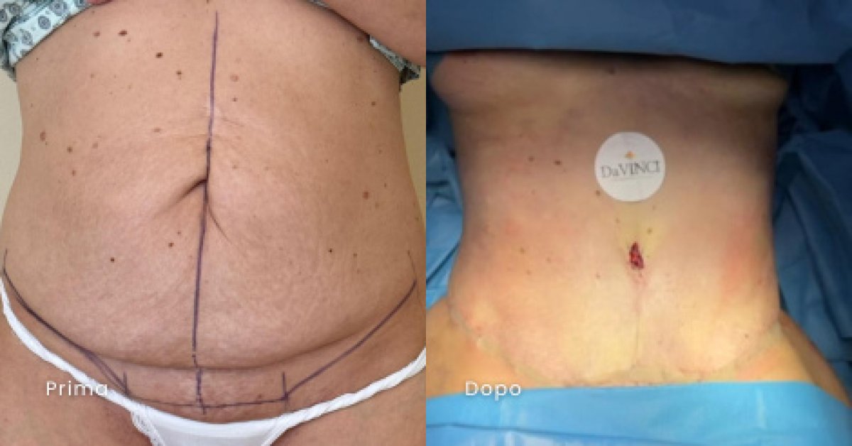 Resultados de abdominoplastia antes y después en clínica Da Vinci – mejora del contorno abdominal