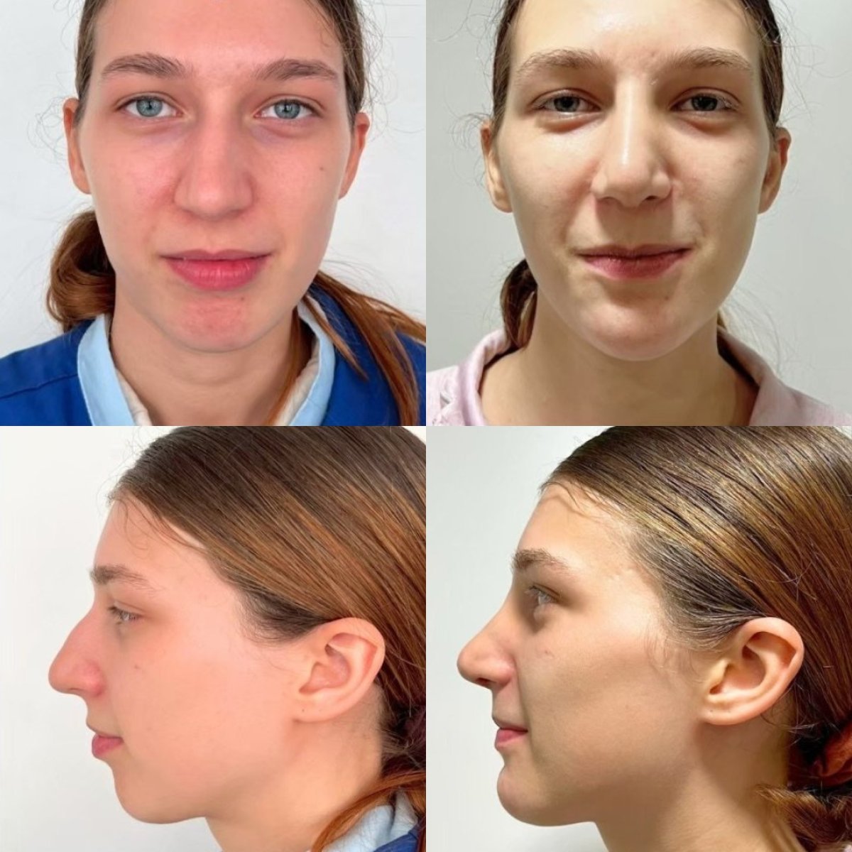 Résultats avant/après tip rhinoplastie à ID Clinic Bangkok, forme et profil du nez améliorés