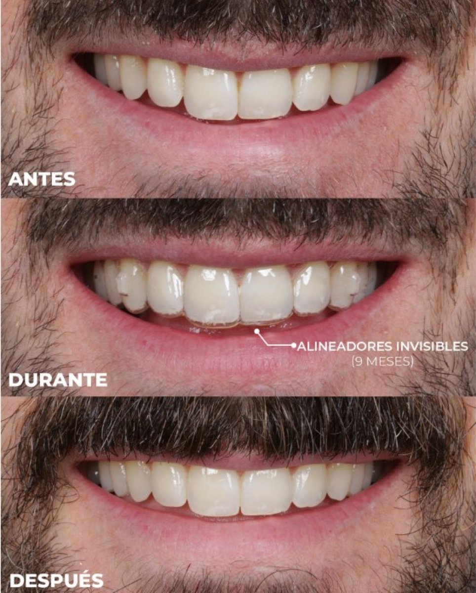 before and after photo