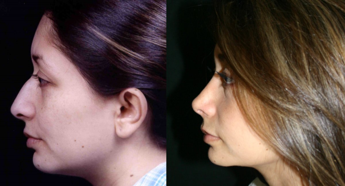 before and after photo