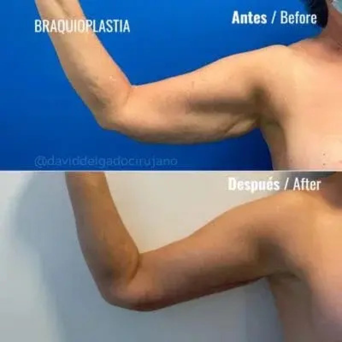 Résultats avant/après lifting des bras (brachioplastie) – contour et peau raffermis