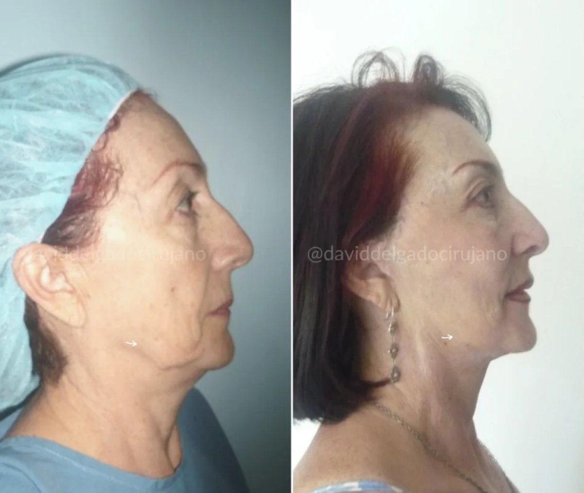before and after photo