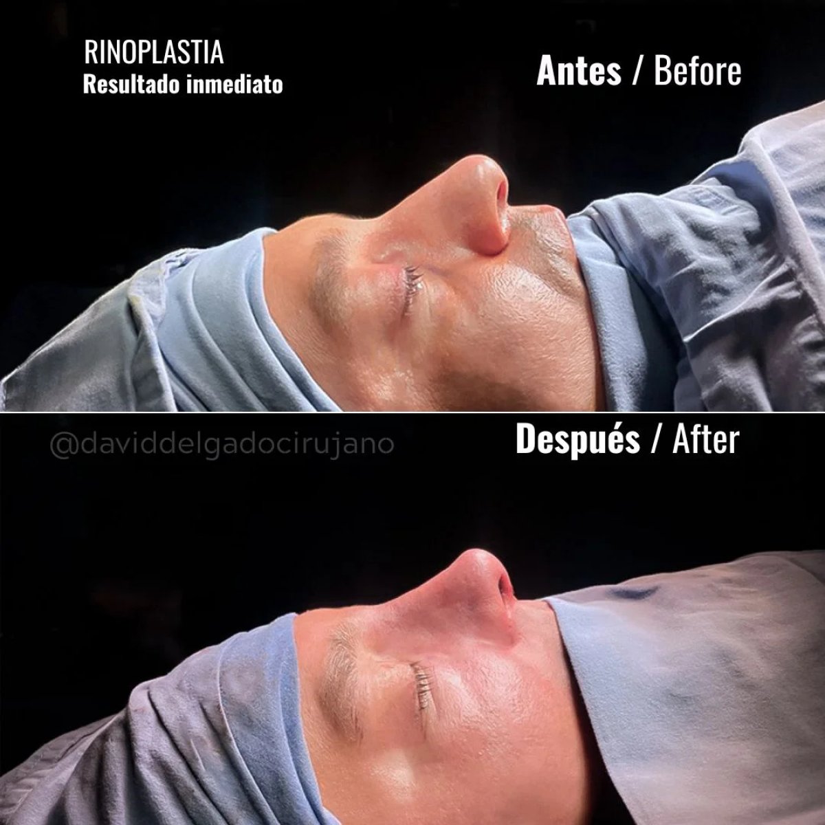 Resultados de rinoplastia antes y después, mejora inmediata en la forma de la nariz