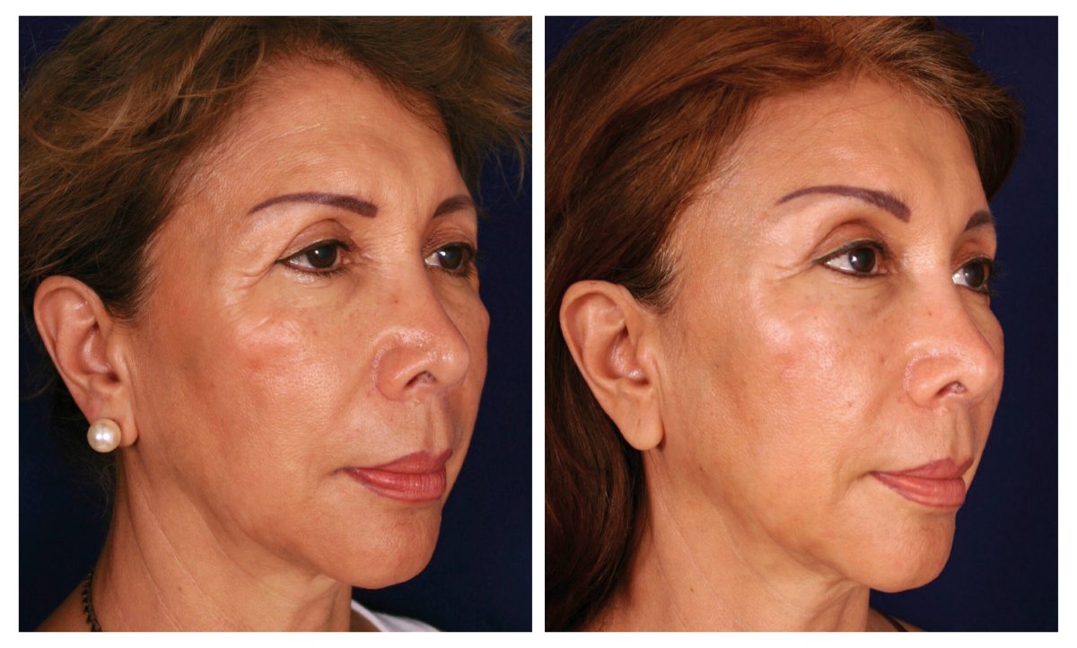 before and after photo