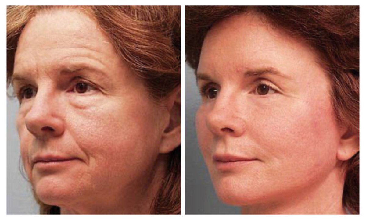 before and after photo