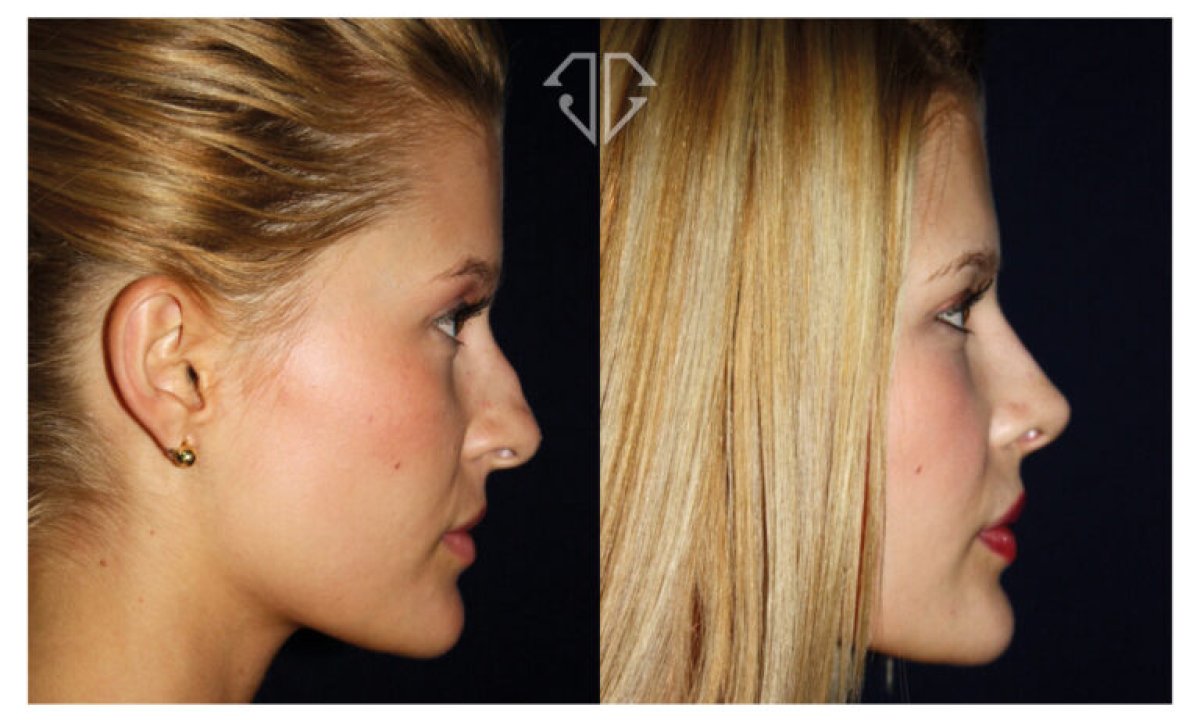 before and after photo