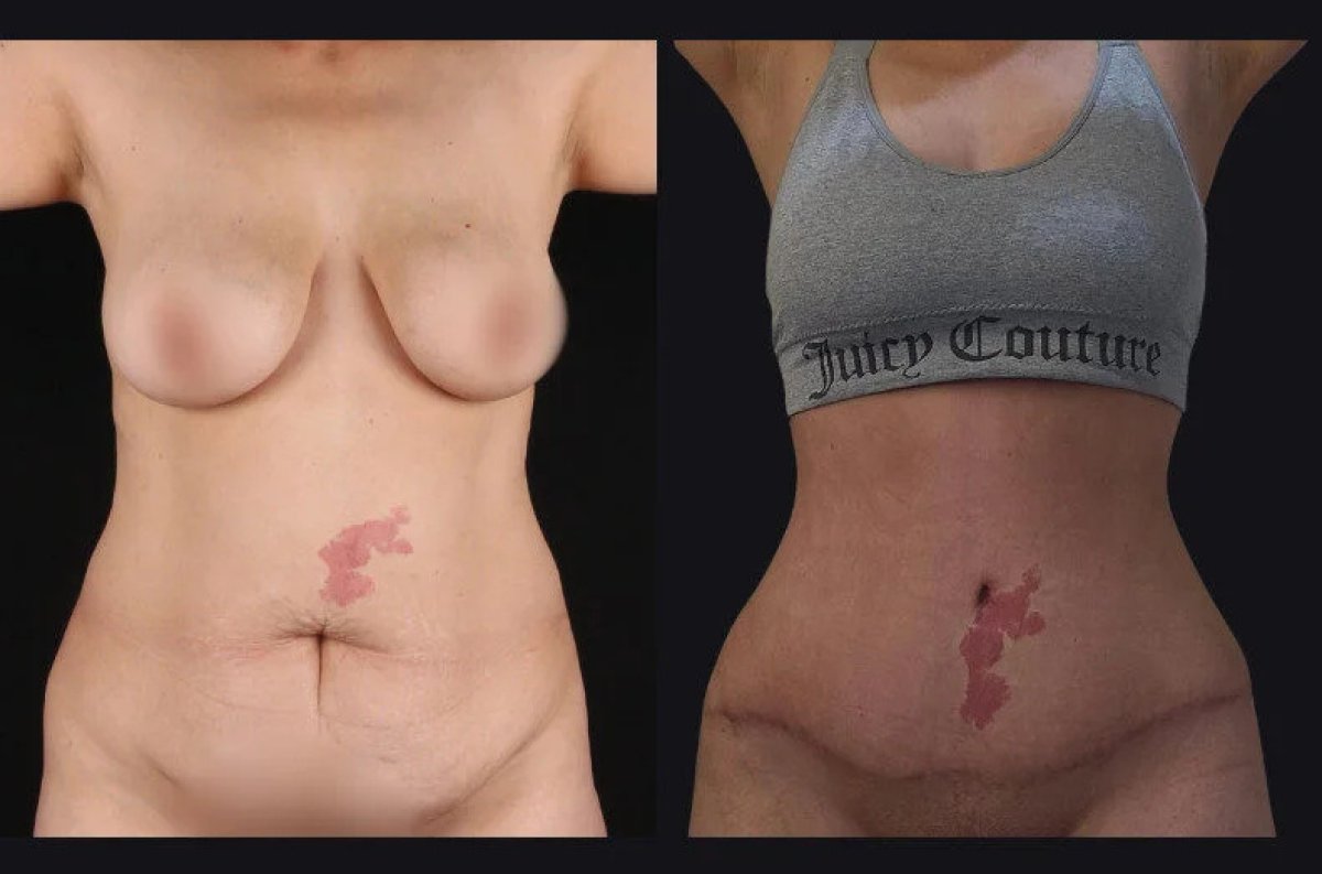 before and after photo