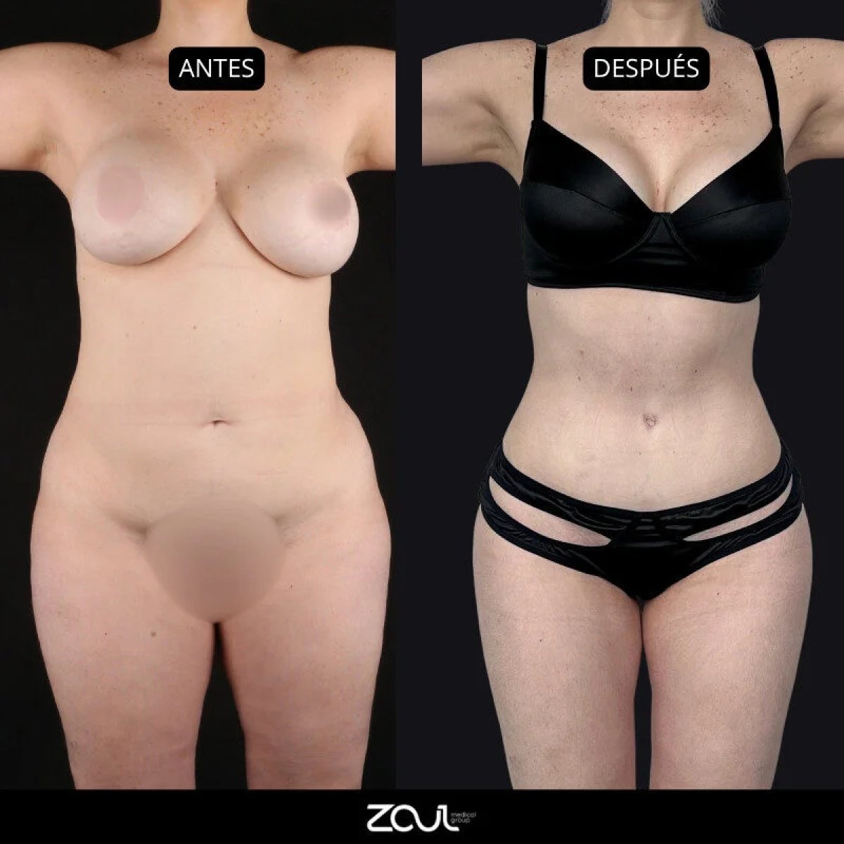 Resultados de abdominoplastia antes y después en Zoul Medical Clinic – mejora del contorno corporal