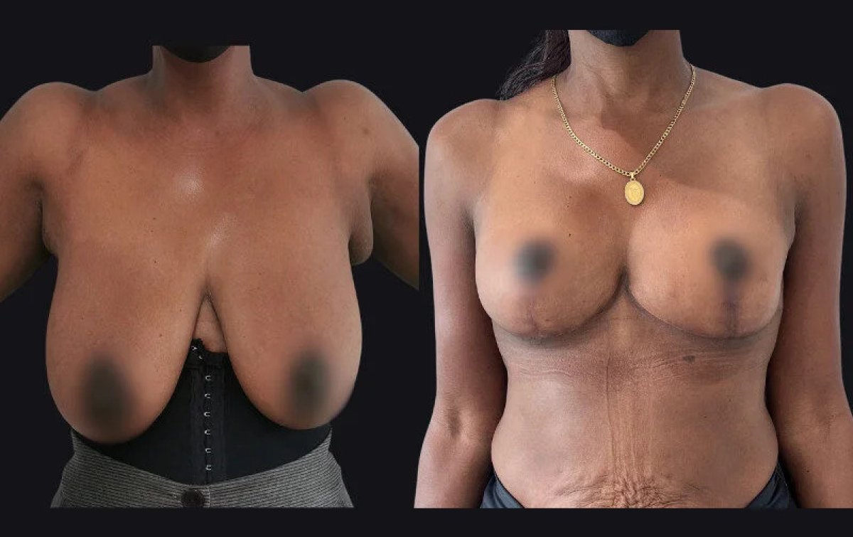 before and after photo