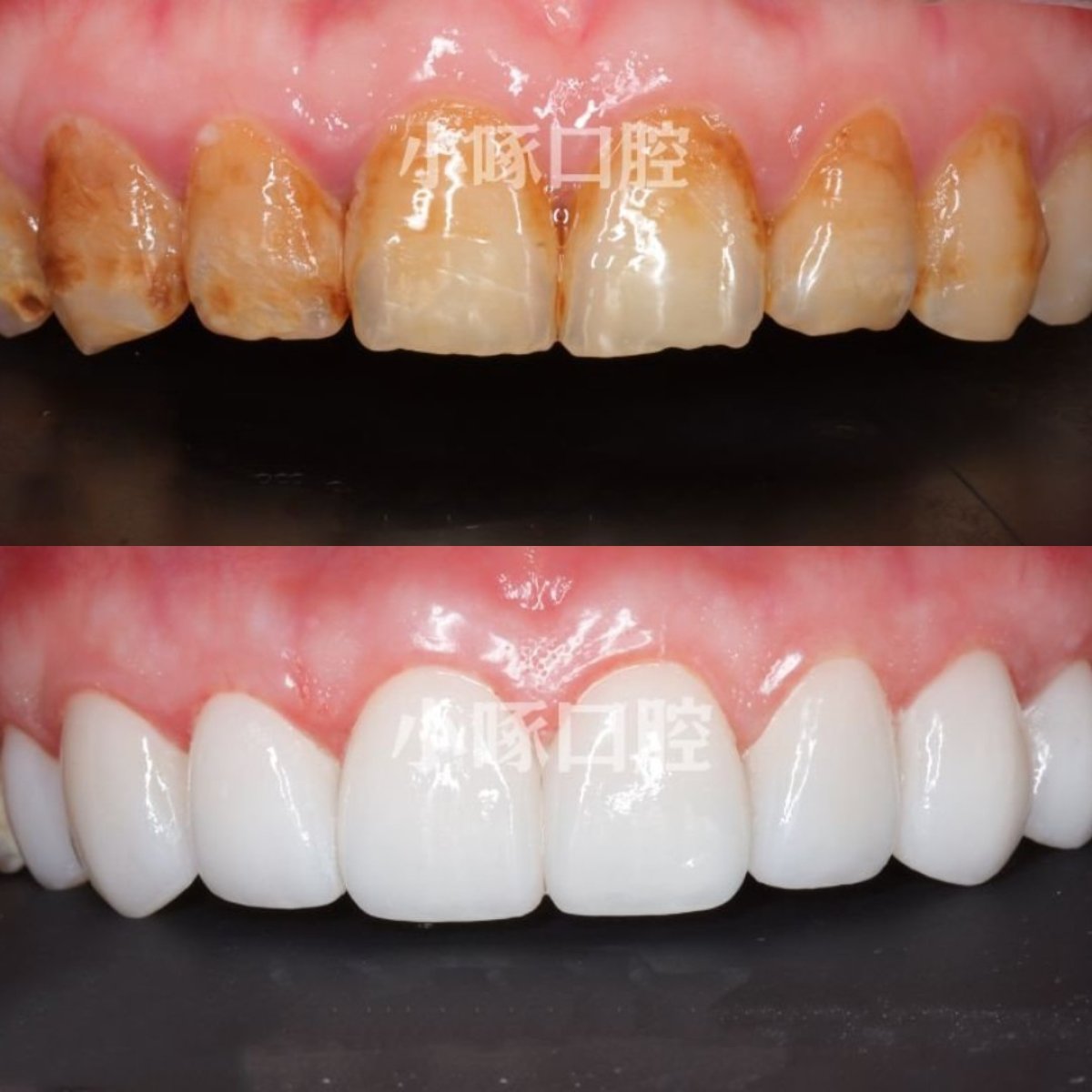 Résultats avant/après facettes dentaires chez VBright Dental – sourire naturel transformé