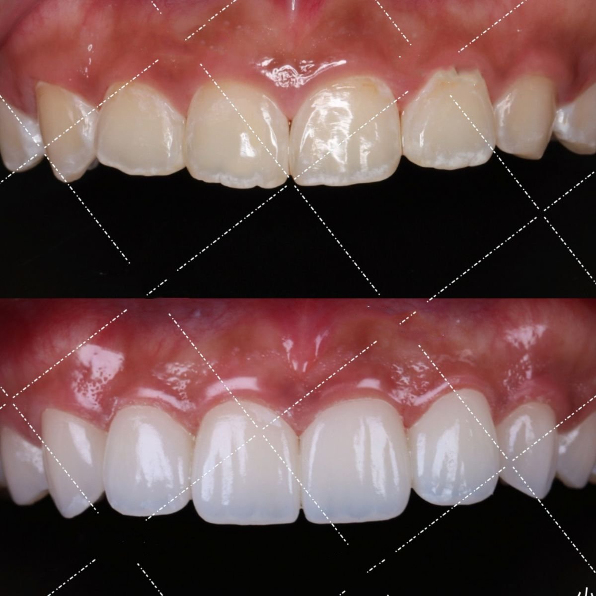 نتائج قبل وبعد الفينير في VBright Dental – ابتسامة محسنة وأسنان أكثر بياضًا