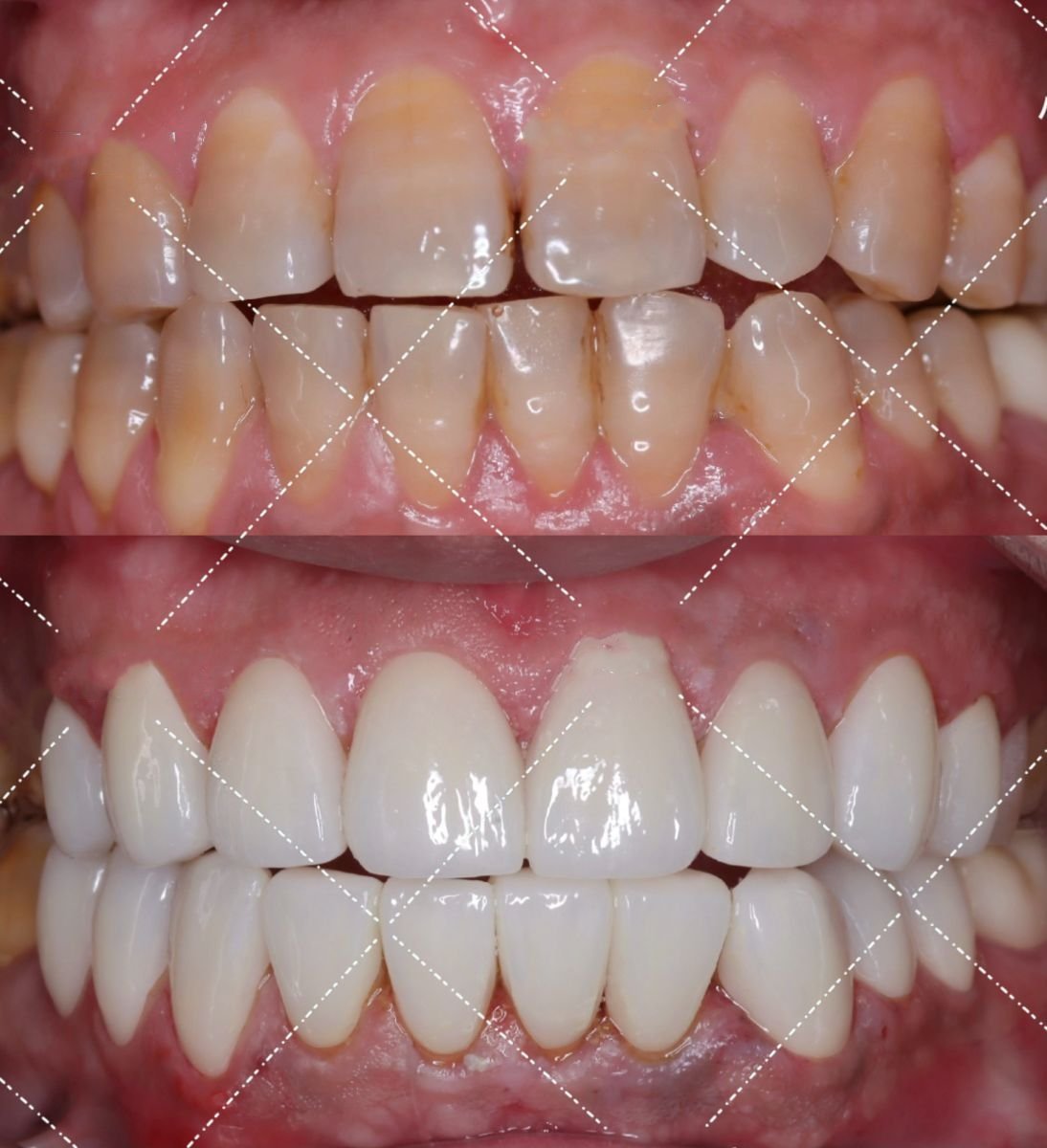قبل وبعد قشور الأسنان في VBright Dental – نتائج تحول الابتسامة