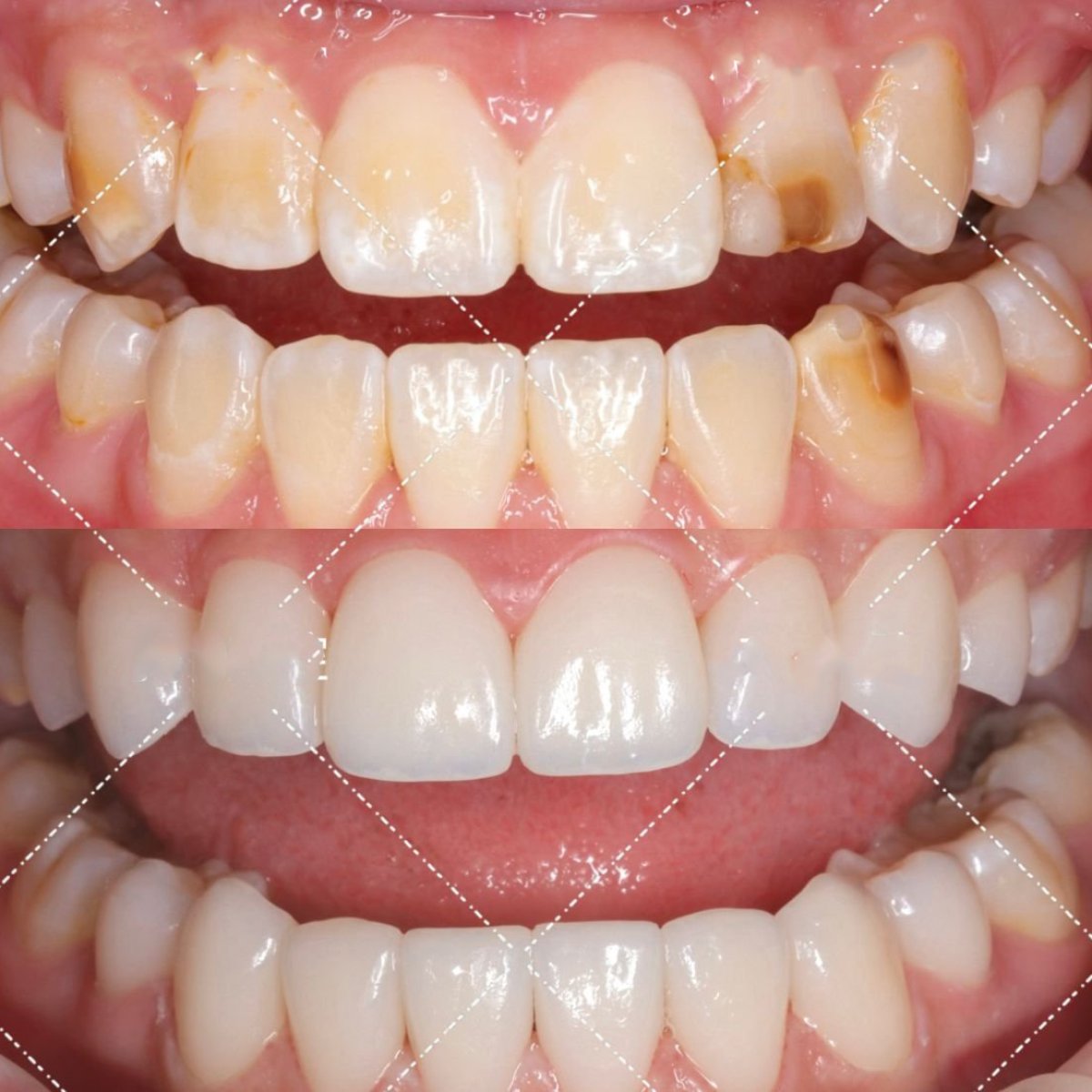 Avant et après facettes dentaires chez VBright Dental – sourire naturel après traitement