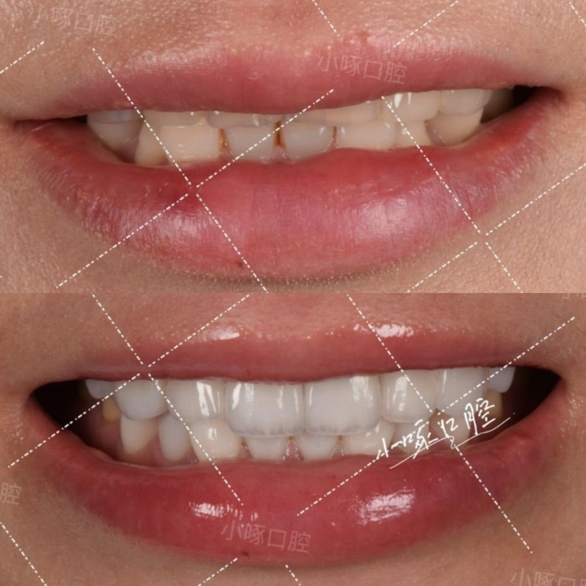 نتائج قبل وبعد الفينير في VBright Dental – ابتسامة محسنة بأسنان بيضاء ومتناسقة