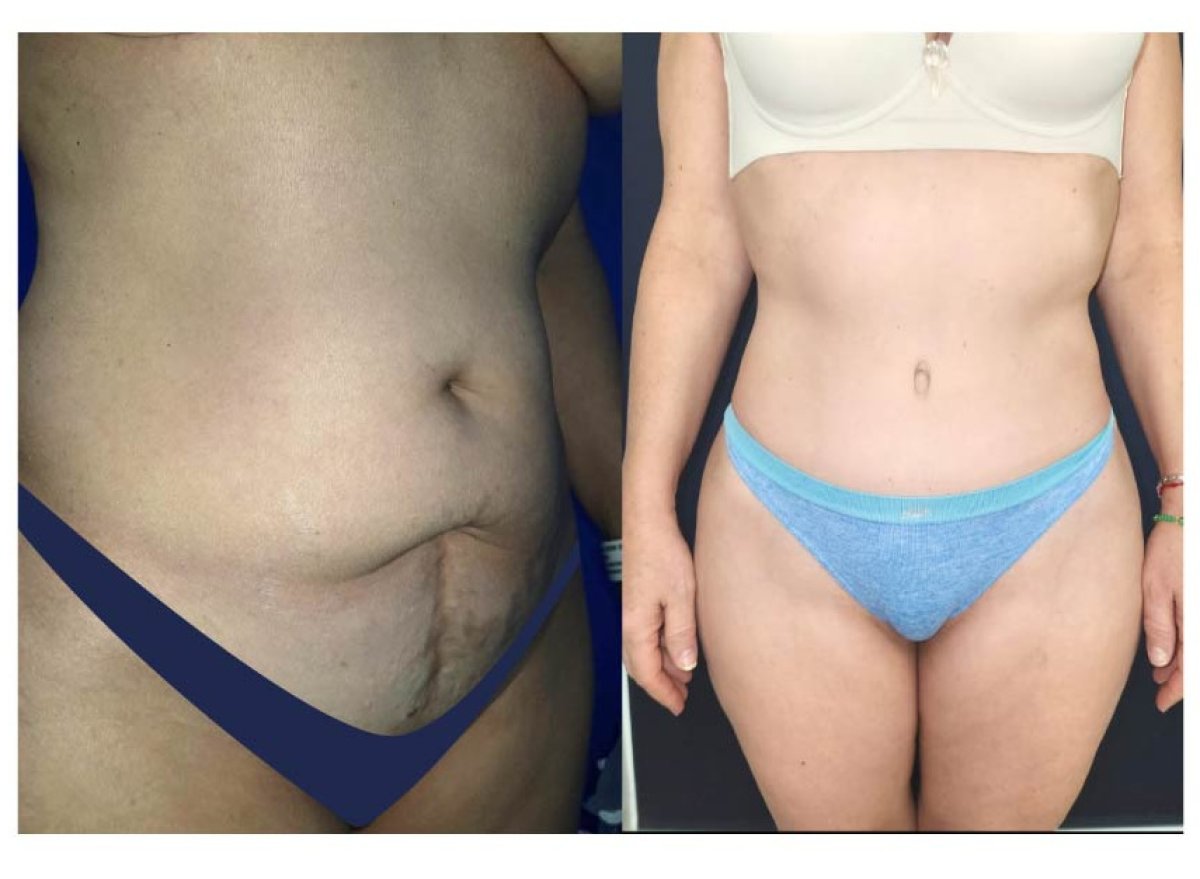 before and after photo