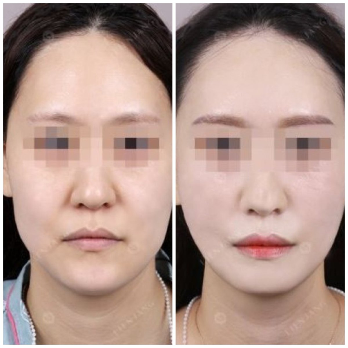 Результат ліпосакції другого підборіддя до і після в Lienjang Plastic Surgery & Aesthetic Clinic