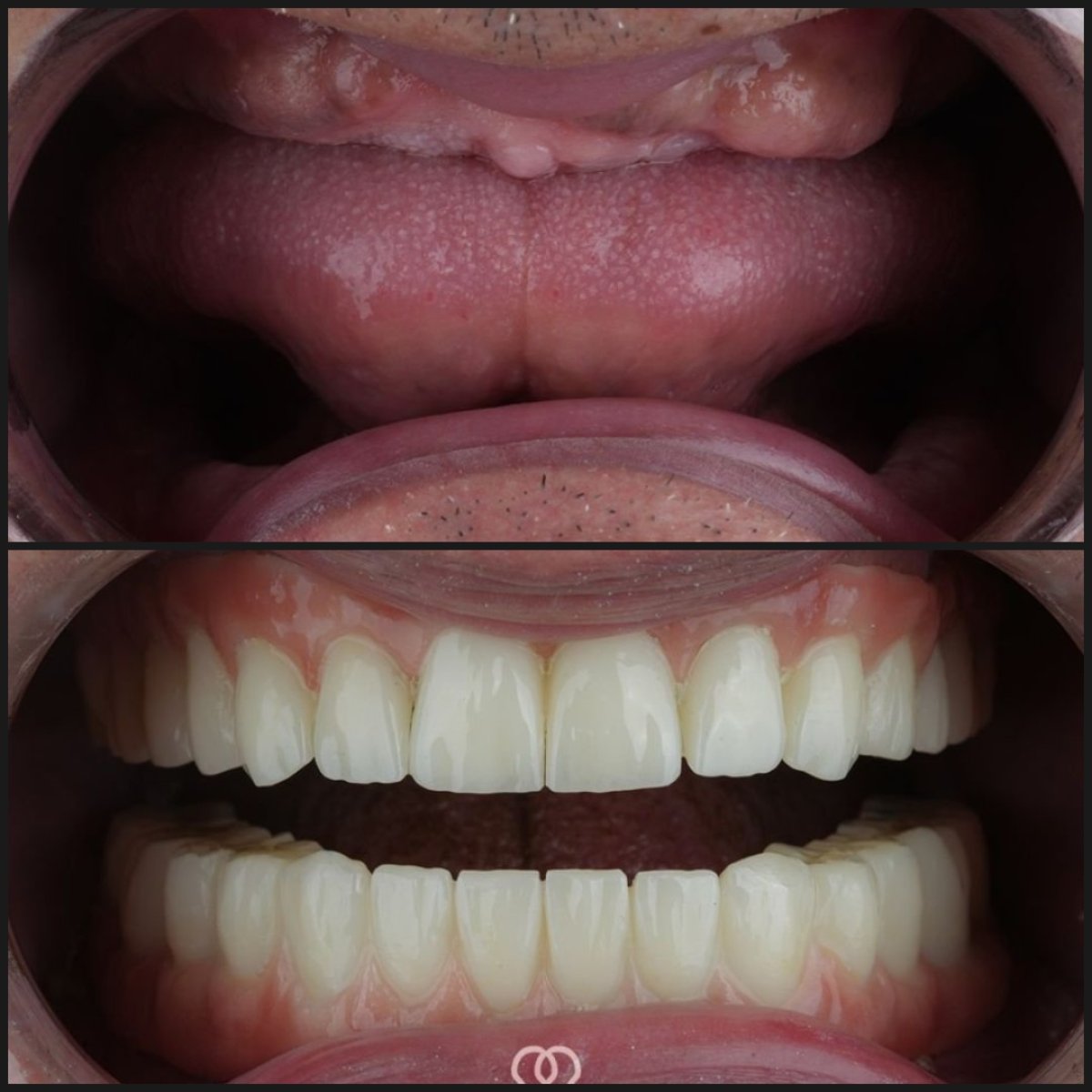 Результати до і після зигоматичних імплантів у Dentaray Clinic – повна реставрація зубів