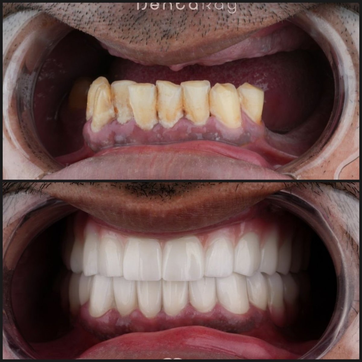 نتائج قبل وبعد زراعة عظم الوجنة في Dentaray Clinic – استعادة الابتسامة الكاملة