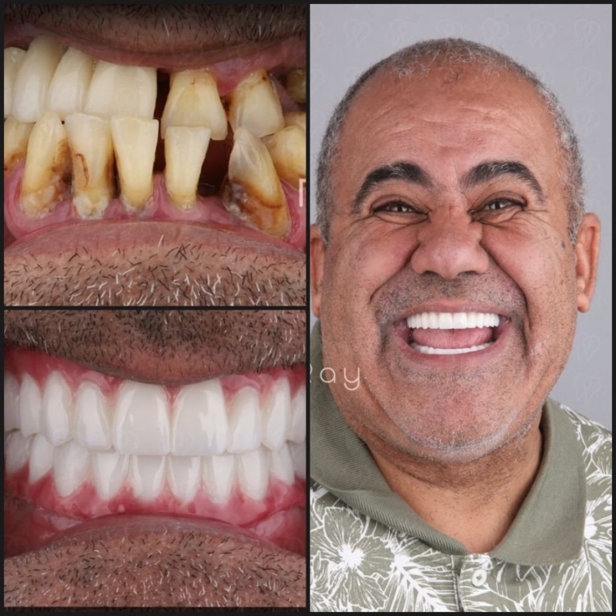 نتائج زراعة الزايغوماتيك قبل وبعد في عيادة Dentaray – استعادة الابتسامة الكاملة