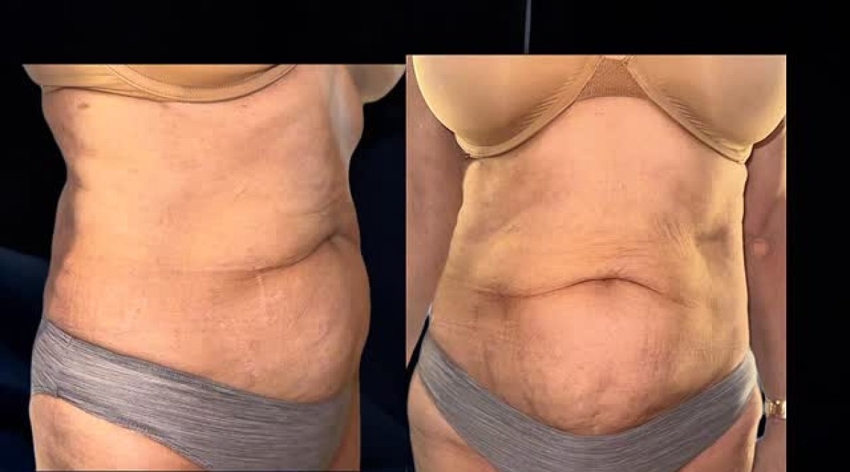 before and after photo