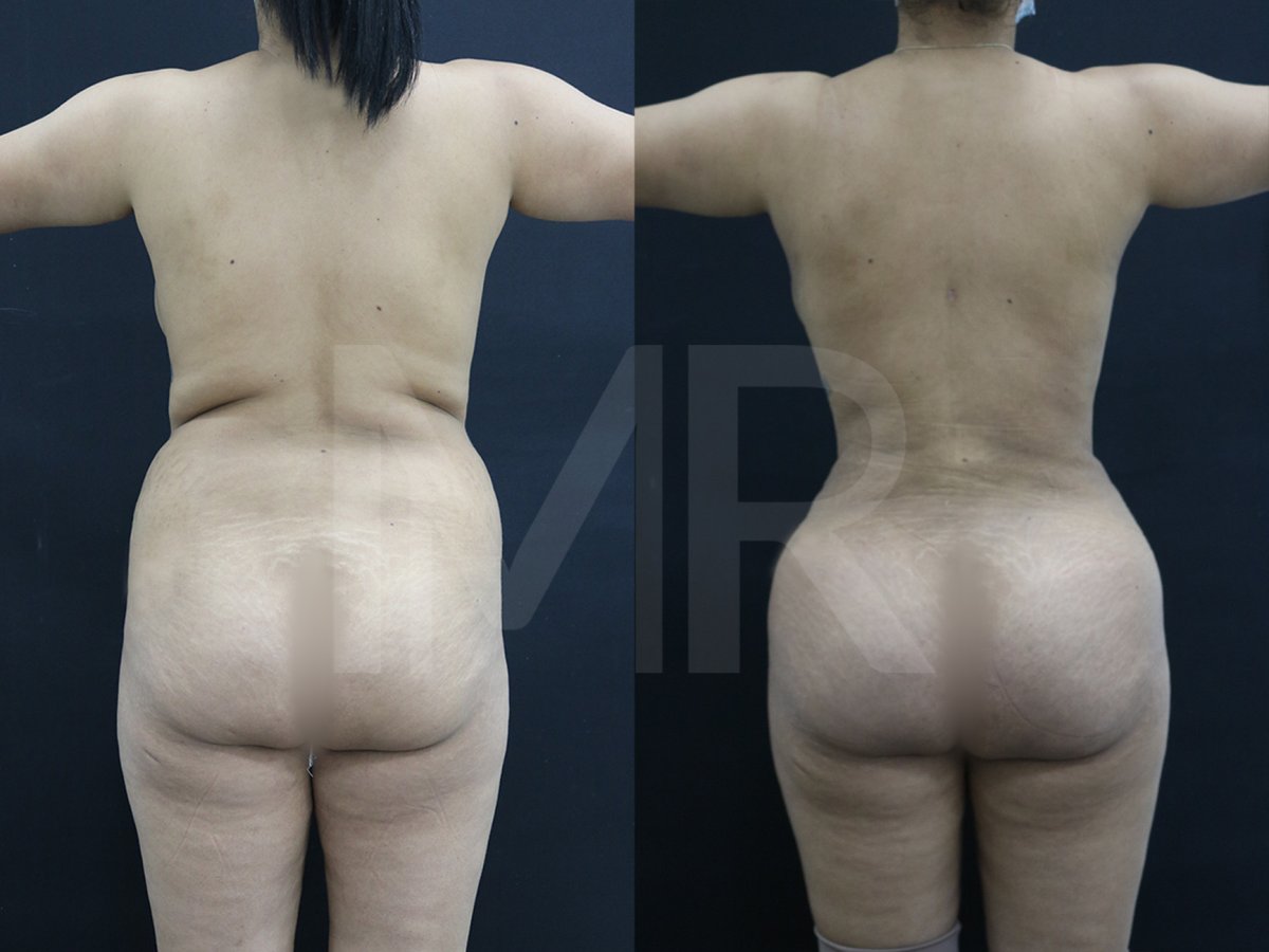 نتائج قبل وبعد عملية Brazilian Butt Lift – تحسين شكل ومحيط الأرداف