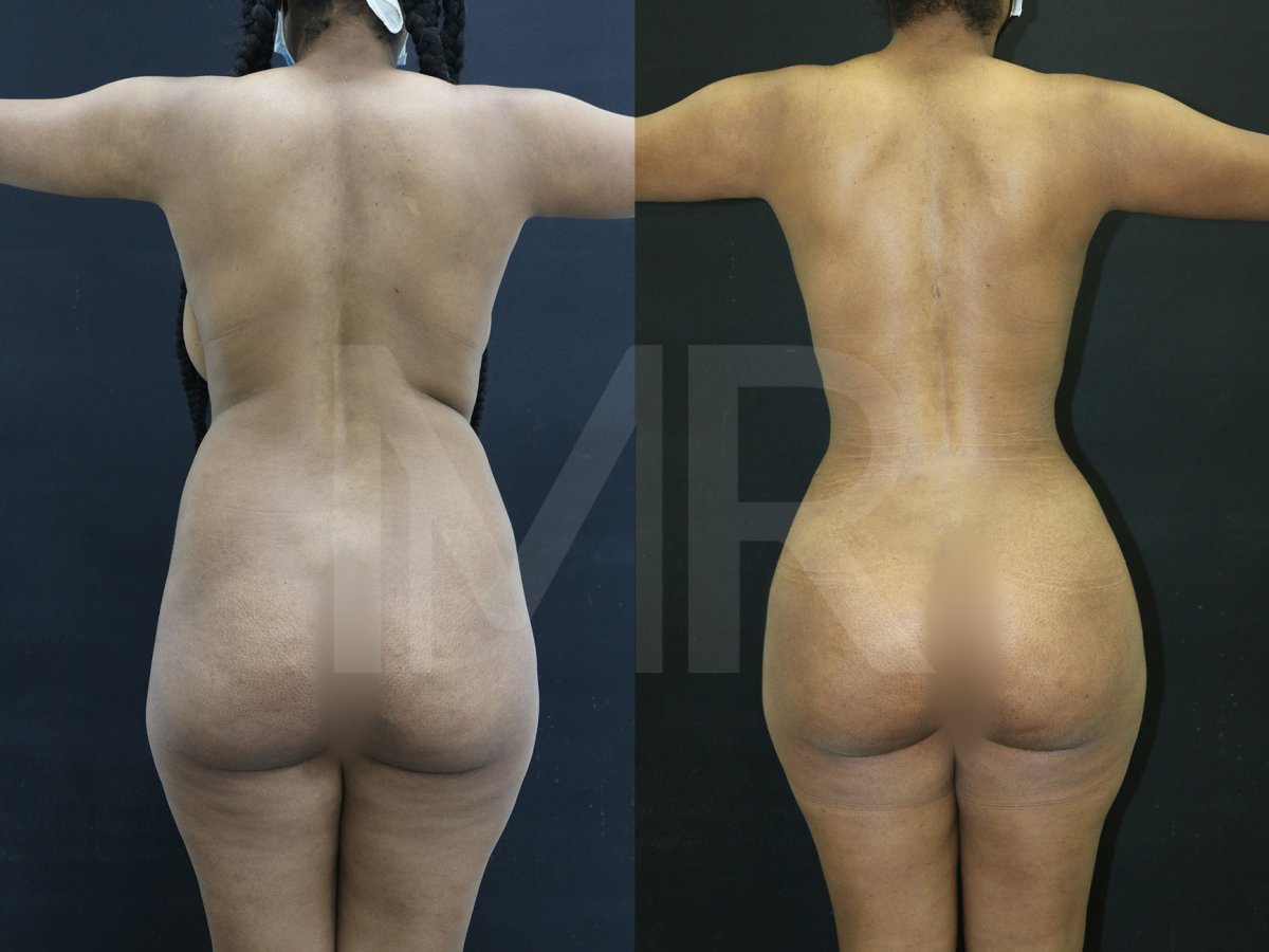 Brazilian Butt Lift before and after results – enhanced curves and fuller buttocks contour