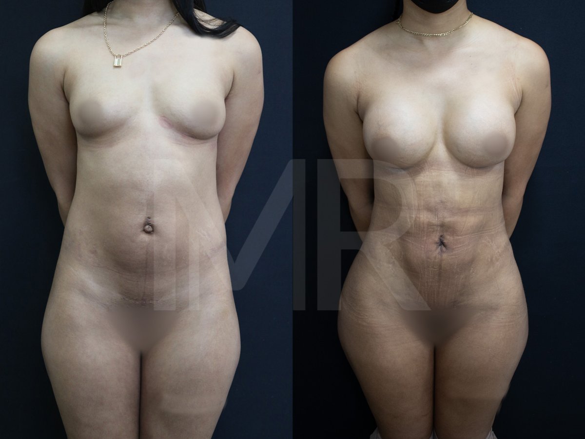 Before and after breast augmentation results – enhanced breast shape and volume