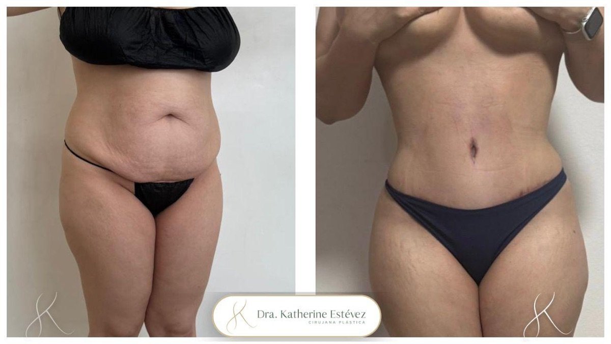 Resultados de abdominoplastia antes y después en clínica Dra. Katherine Estévez – abdomen plano