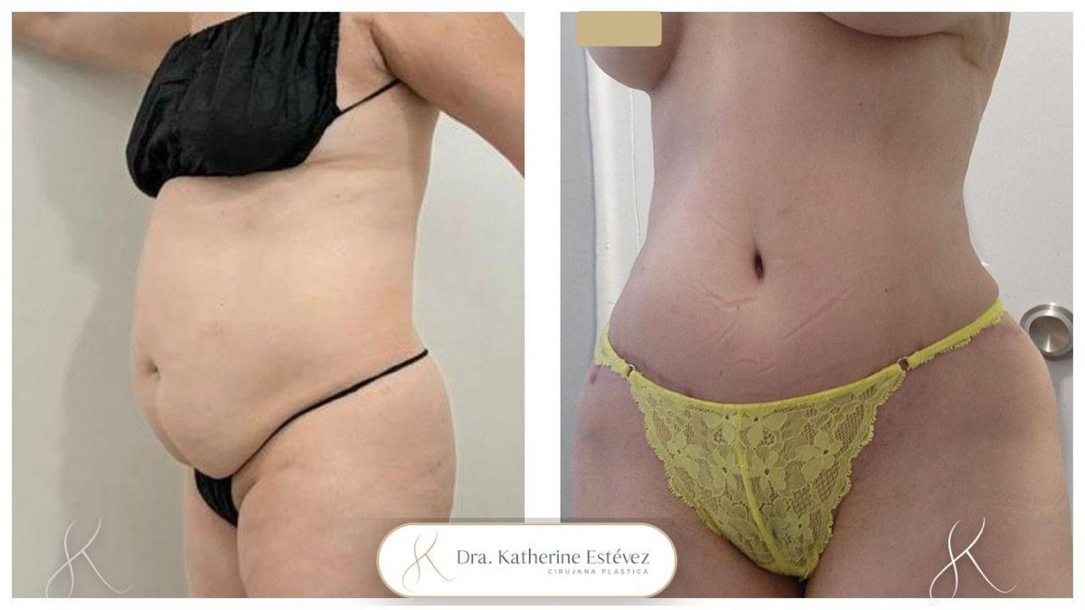 Resultados de abdominoplastia antes y después en clínica Dra. Katherine Estévez – abdomen plano