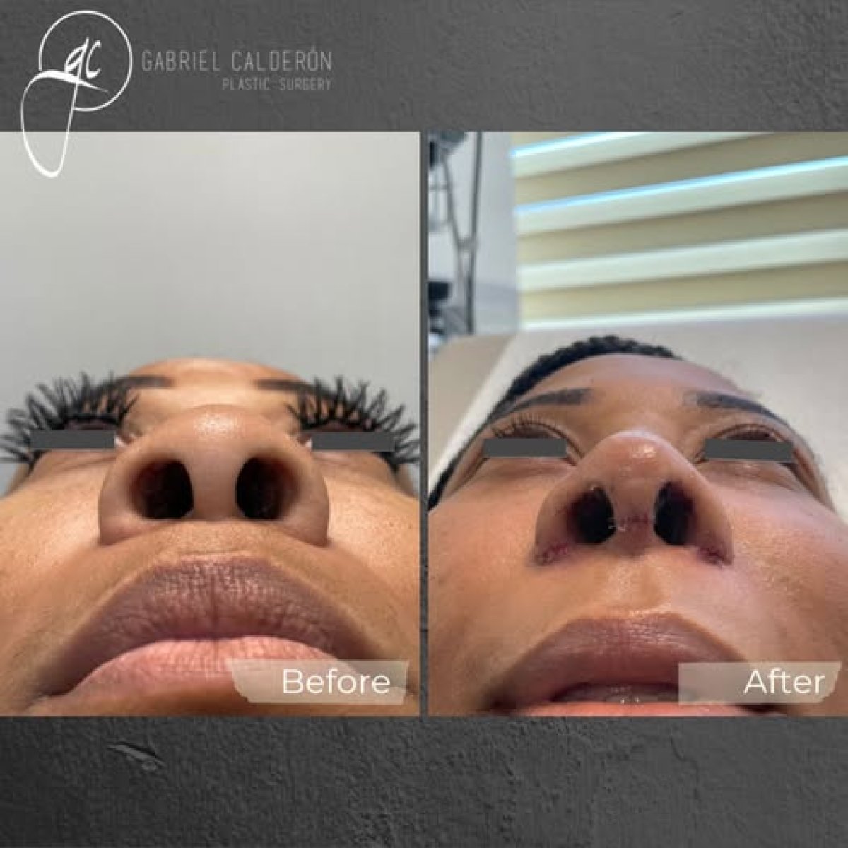 Resultados de rinoplastia antes y después en Gabriel Calderón Plastic Surgery, remodelación nasal