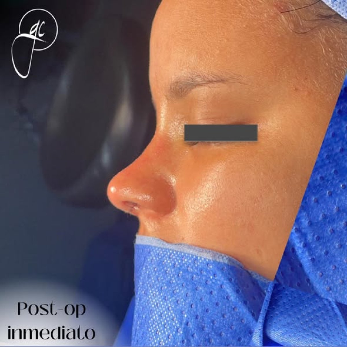 Resultado inmediato tras rinoplastia, perfil nasal mejorado en la clínica