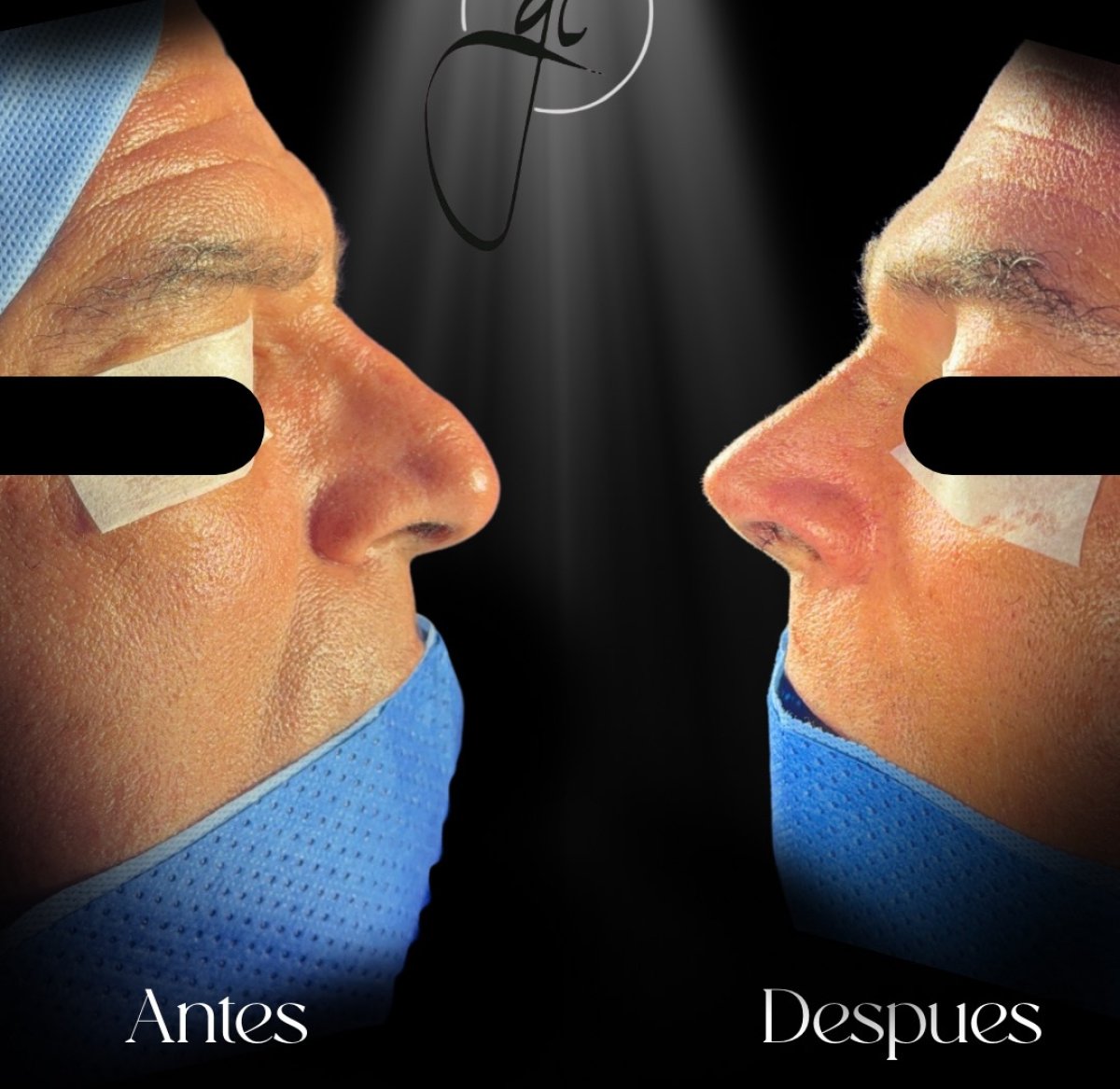 Resultados de rinoplastia antes y después en hombre, mejora de forma y perfil nasal