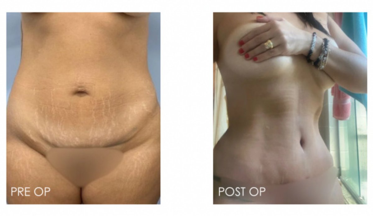 Liposuktion Vorher-Nachher-Ergebnisse – sichtbare Verbesserung der Bauchkontur