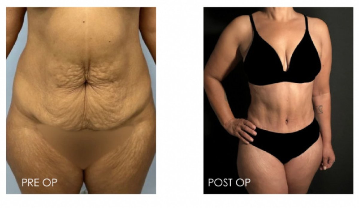 Liposuktion Vorher-Nachher-Ergebnisse – sichtbare Bauchkontur und Hautstraffung