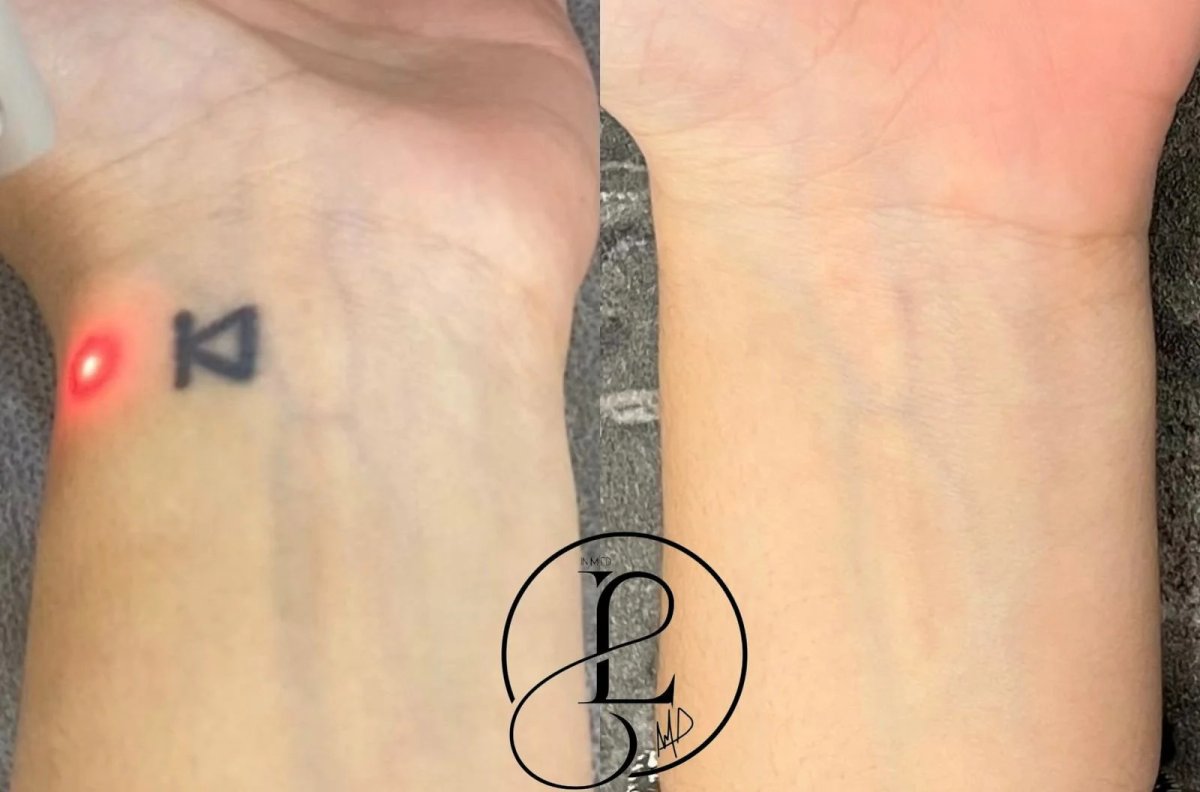 Resultados antes y después de la eliminación de tatuajes con láser en la muñeca