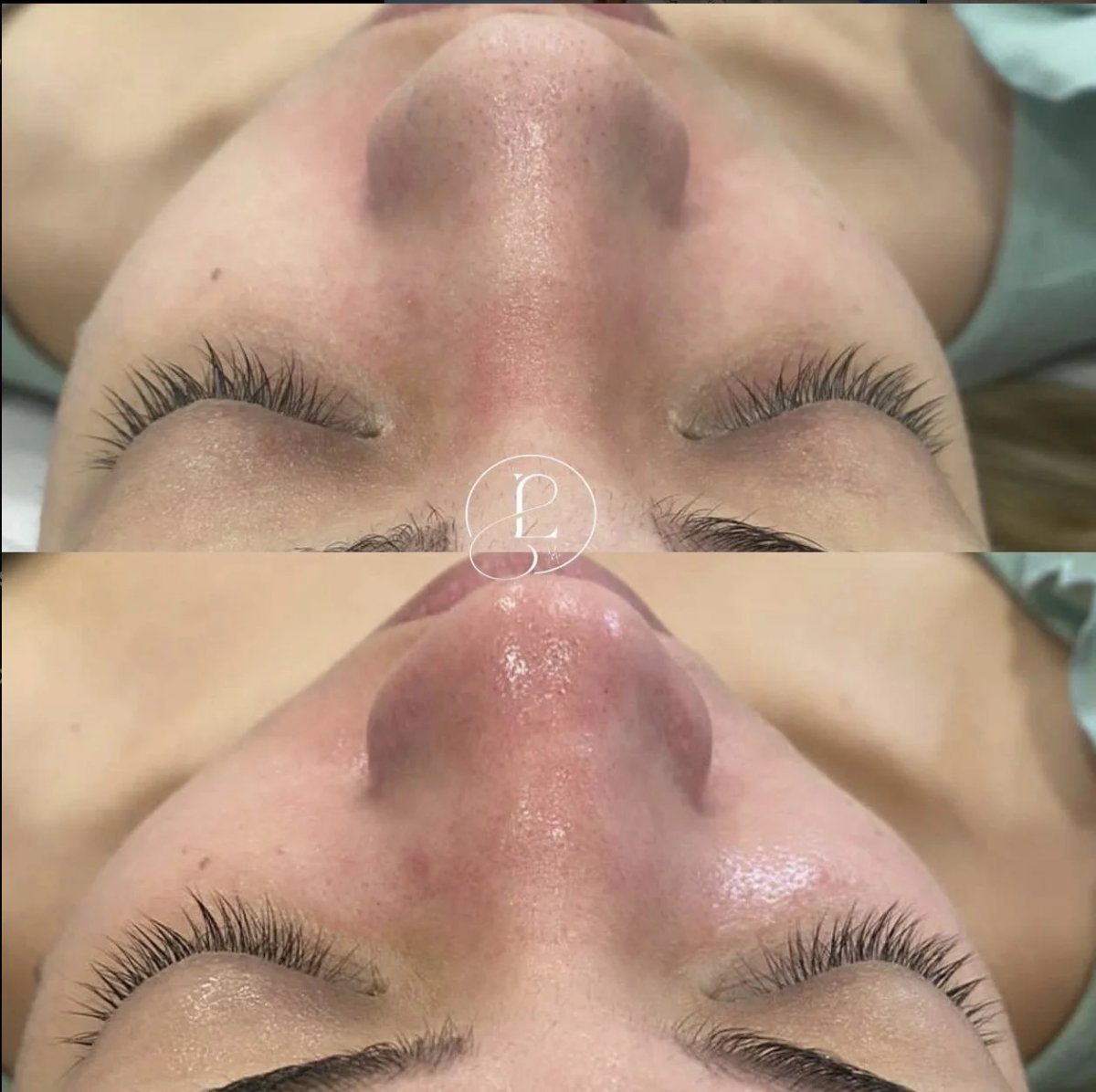 Resultados antes y después de dermoabrasión Hydrafacial: piel más suave y luminosa