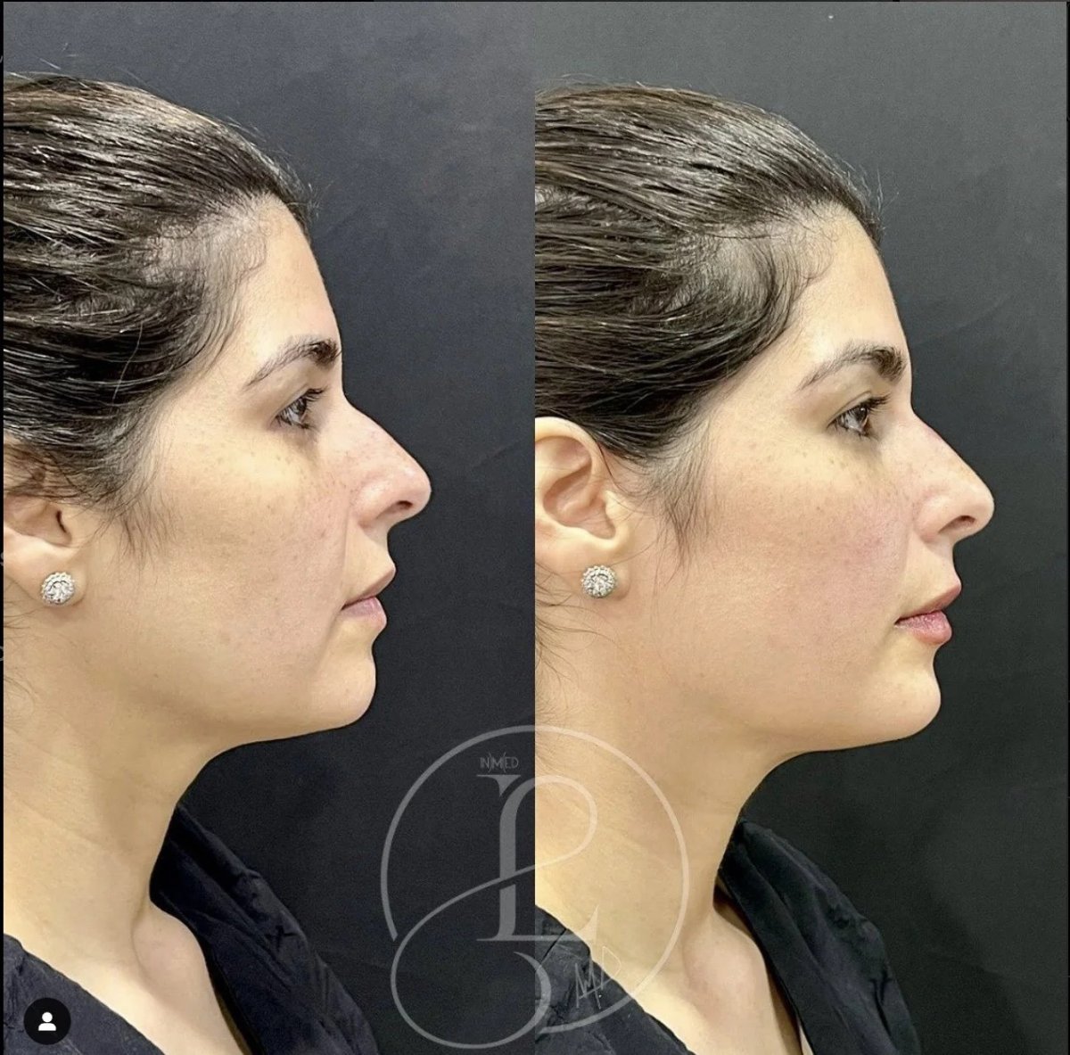 Resultados de lifting facial no quirúrgico antes y después – contorno facial mejorado