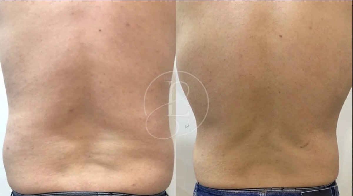 Resultados antes y después de criolipólisis – reducción visible de grasa en la zona lumbar