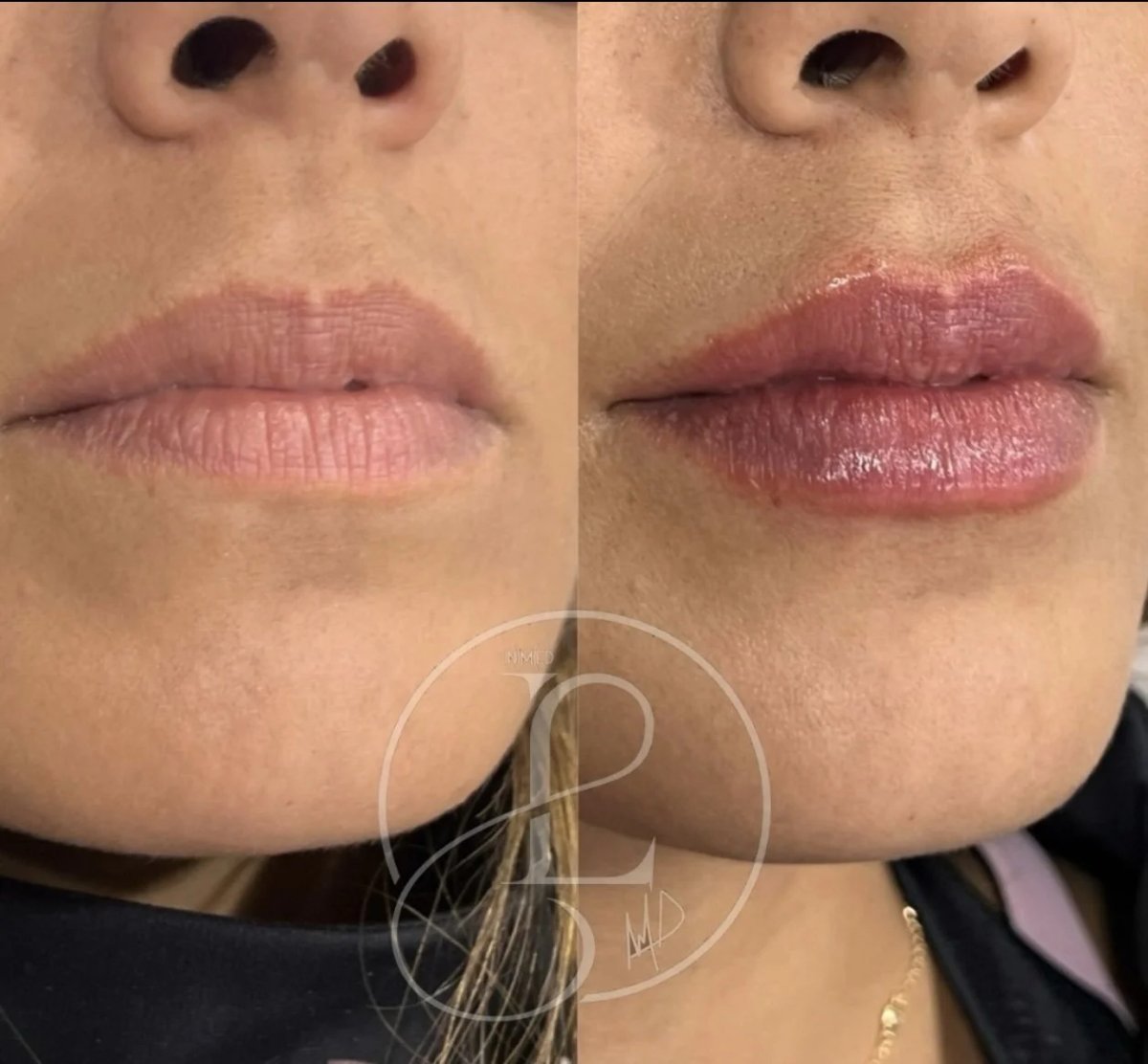 Resultados antes y después de relleno de labios: mayor volumen y mejor contorno labial